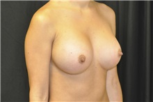 Breast Augmentation After Photo by Andrew Smith, MD; Irvine, CA - Case 28972