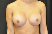 Breast Augmentation After Photo by Andrew Smith, MD; Irvine, CA - Case 28972