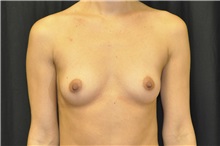 Breast Augmentation Before Photo by Andrew Smith, MD; Irvine, CA - Case 28972