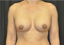 Breast Augmentation After Photo by Andrew Smith, MD; Irvine, CA - Case 29007