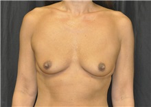 Breast Augmentation Before Photo by Andrew Smith, MD; Irvine, CA - Case 29007