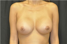 Breast Augmentation After Photo by Andrew Smith, MD; Irvine, CA - Case 29008