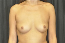 Breast Augmentation Before Photo by Andrew Smith, MD; Irvine, CA - Case 29008