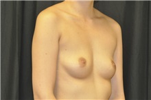 Breast Augmentation Before Photo by Andrew Smith, MD; Irvine, CA - Case 29016
