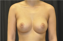 Breast Augmentation After Photo by Andrew Smith, MD; Irvine, CA - Case 29016