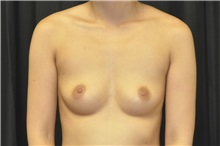 Breast Augmentation Before Photo by Andrew Smith, MD; Irvine, CA - Case 29016