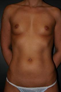 Breast Augmentation Before Photo by Steven Gitt, MD; Phoenix, AZ - Case 7133