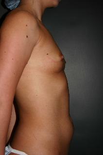 Breast Augmentation Before Photo by Steven Gitt, MD; Phoenix, AZ - Case 7133