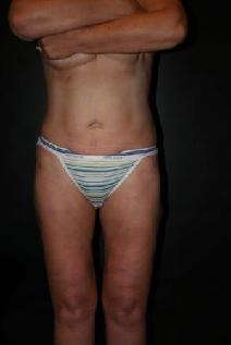 Liposuction After Photo by Steven Gitt, MD; Phoenix, AZ - Case 7230