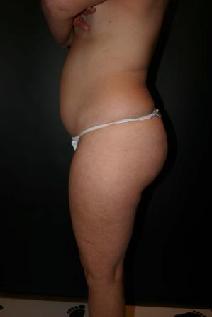 Liposuction Before Photo by Steven Gitt, MD; Phoenix, AZ - Case 7230