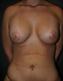 Breast Augmentation After Photo by Steven Gitt, MD; Phoenix, AZ - Case 7277