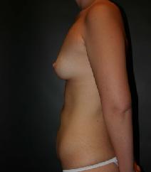 Breast Augmentation Before Photo by Steven Gitt, MD; Phoenix, AZ - Case 7277