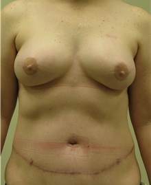 Breast Reconstruction After Photo by Steven Pisano, MD; San Antonio, TX - Case 30102