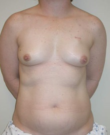 Breast Reconstruction Before Photo by Steven Pisano, MD; San Antonio, TX - Case 30102