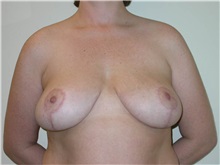 Breast Lift After Photo by Steven Pisano, MD; San Antonio, TX - Case 30111