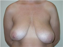 Breast Lift Before Photo by Steven Pisano, MD; San Antonio, TX - Case 30111