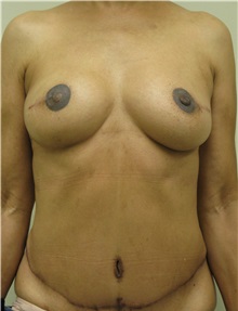 Free Flap Breast Reconstruction After Photo by Steven Pisano, MD; San Antonio, TX - Case 30112