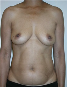 Free Flap Breast Reconstruction Before Photo by Steven Pisano, MD; San Antonio, TX - Case 30112