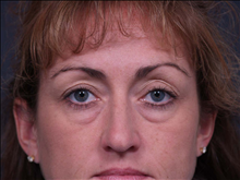 Eyelid Surgery Before Photo by John Corey, MD; Scottsdale, AZ - Case 24712