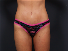 Tummy Tuck After Photo by John Corey, MD; Scottsdale, AZ - Case 24716