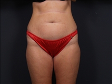 Tummy Tuck Before Photo by John Corey, MD; Scottsdale, AZ - Case 24716