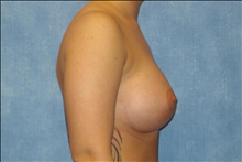 Breast Augmentation After Photo by George John Alexander, MD, FACS; ,  - Case 24011