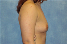 Breast Augmentation Before Photo by George John Alexander, MD, FACS; ,  - Case 24011