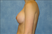 Breast Augmentation After Photo by George John Alexander, MD, FACS; ,  - Case 24012