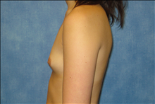 Breast Augmentation Before Photo by George John Alexander, MD, FACS; ,  - Case 24012