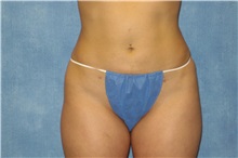 Liposuction After Photo by George John Alexander, MD, FACS; ,  - Case 24106