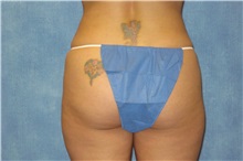 Liposuction After Photo by George John Alexander, MD, FACS; ,  - Case 24106
