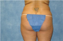 Liposuction Before Photo by George John Alexander, MD, FACS; ,  - Case 24106