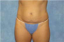 Tummy Tuck Before Photo by George John Alexander, MD, FACS; ,  - Case 31276