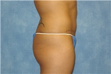 Tummy Tuck After Photo by George John Alexander, MD, FACS; ,  - Case 31276