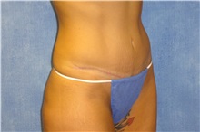 Tummy Tuck After Photo by George John Alexander, MD, FACS; ,  - Case 31278