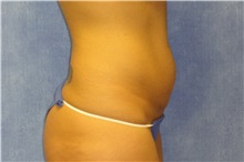 Tummy Tuck Before Photo by George John Alexander, MD, FACS; ,  - Case 31278
