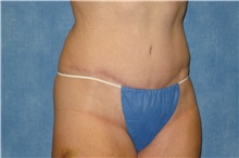 Tummy Tuck After Photo by George John Alexander, MD, FACS; ,  - Case 31279