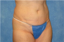 Tummy Tuck Before Photo by George John Alexander, MD, FACS; ,  - Case 31279