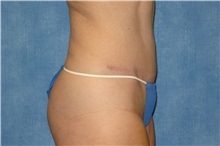 Tummy Tuck After Photo by George John Alexander, MD, FACS; ,  - Case 31279