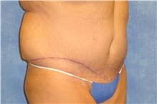 Tummy Tuck After Photo by George John Alexander, MD, FACS; ,  - Case 31282
