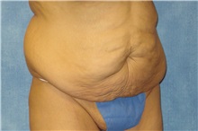 Tummy Tuck Before Photo by George John Alexander, MD, FACS; ,  - Case 31282