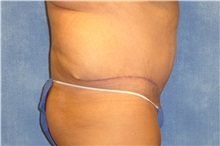 Tummy Tuck After Photo by George John Alexander, MD, FACS; ,  - Case 31282