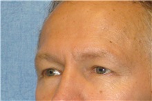 Eyelid Surgery Before Photo by George John Alexander, MD, FACS; ,  - Case 31283