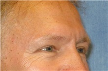 Eyelid Surgery After Photo by George John Alexander, MD, FACS; ,  - Case 31283