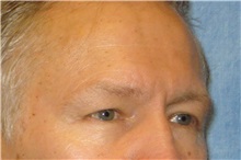 Eyelid Surgery Before Photo by George John Alexander, MD, FACS; ,  - Case 31283