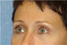 Eyelid Surgery After Photo by George John Alexander, MD, FACS; Las Vegas, NV - Case 31284