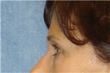 Eyelid Surgery Before Photo by George John Alexander, MD, FACS; Las Vegas, NV - Case 31284