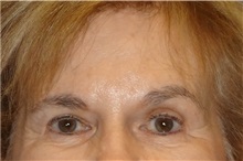 Eyelid Surgery After Photo by George John Alexander, MD, FACS; Las Vegas, NV - Case 31285