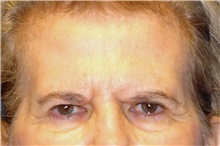 Eyelid Surgery Before Photo by George John Alexander, MD, FACS; Las Vegas, NV - Case 31285