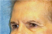 Eyelid Surgery Before Photo by George John Alexander, MD, FACS; ,  - Case 31285